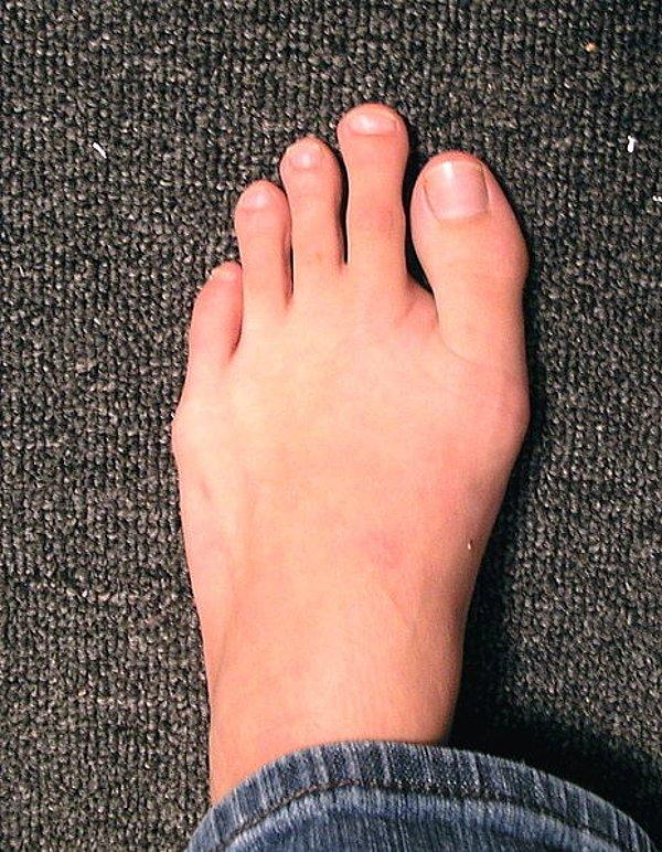 3. Morton Toe: Ikinci ayak parmağının başparmaktan daha büyük olmasına verilen ad.