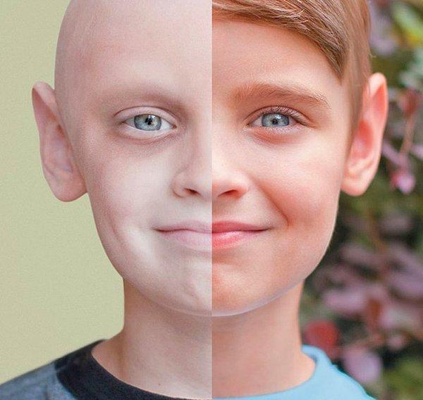 2. Kanseri yenmiş bir çocuğun gülümseyen yüzü.