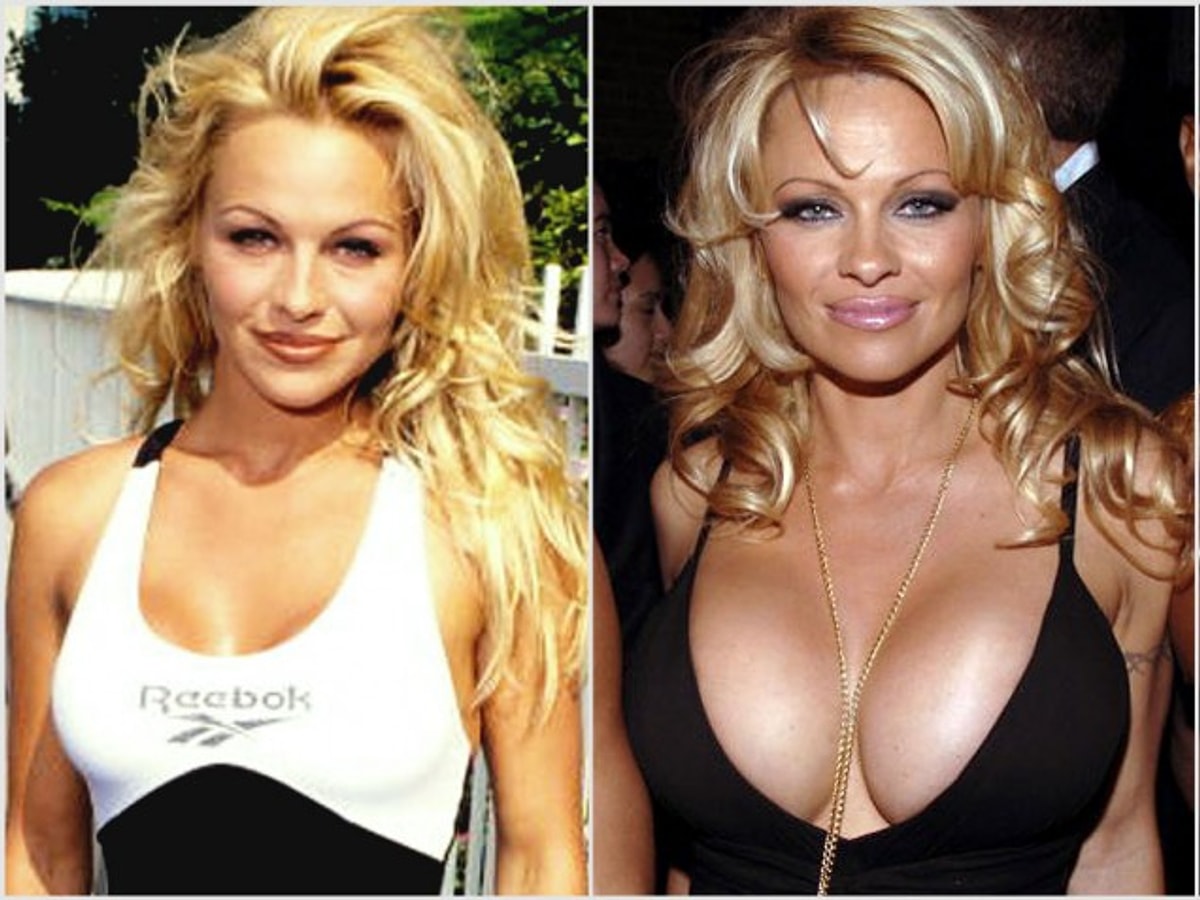 Celebrity before and after breast implants