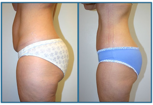 2. Liposuction (Yağ alma)