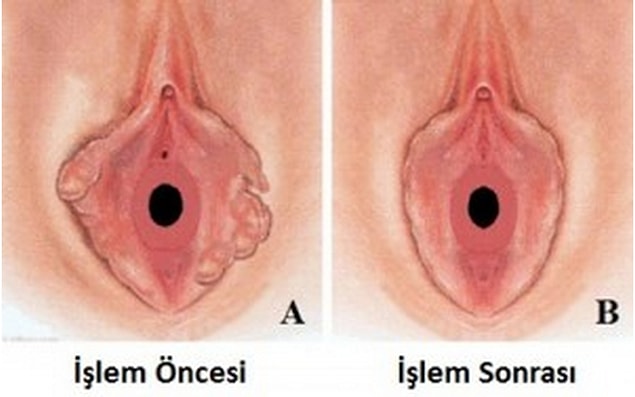 16. Labiaplasty