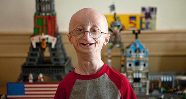 13. Progeria (Yaşlı Görünme Sendromu)