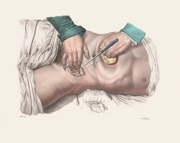 6. Ayrıca o dönemde, cerrahide uygulanan tekniklerin, hastanın acı çekmesini engelleyecek mahiyette olmadığını belirtmemiz gerekir.