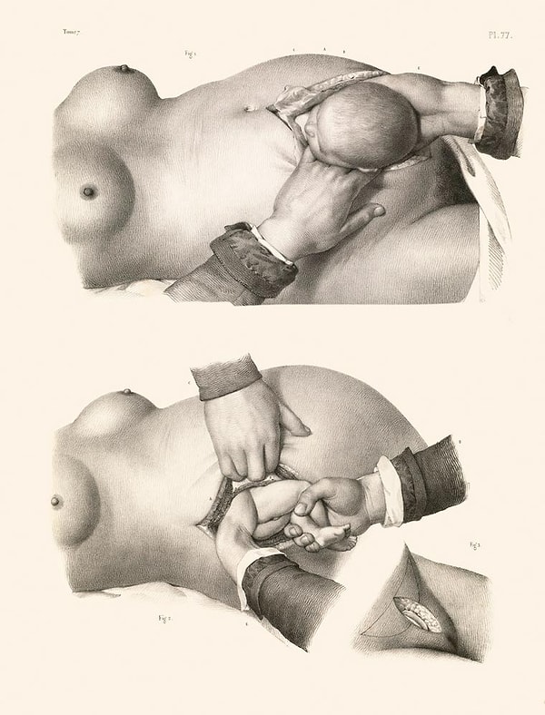 7. Acının ortadan kaldırılması yönünde ilk adım, 1844’de Amerikalı dişçi Horace Wells’in (1815-48) diş çekiminde güldürücü gaz (nitröz oksit) kullanmasıyla atıldı.