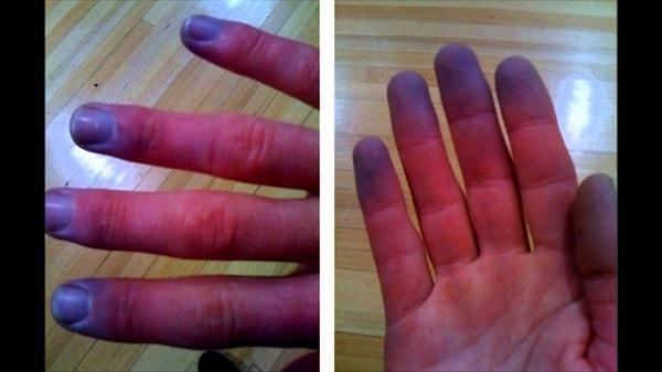 12. En sonunda elleriniz ısınmaya başladığında, ani kan akışından dolayı parmaklarınız morarır.