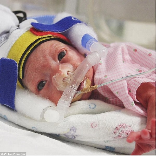 Деовочка родилсь с весом 690 грамм