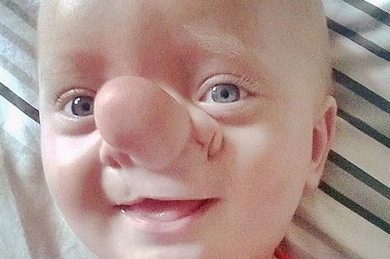 Малыш с растущим в носу мозгом