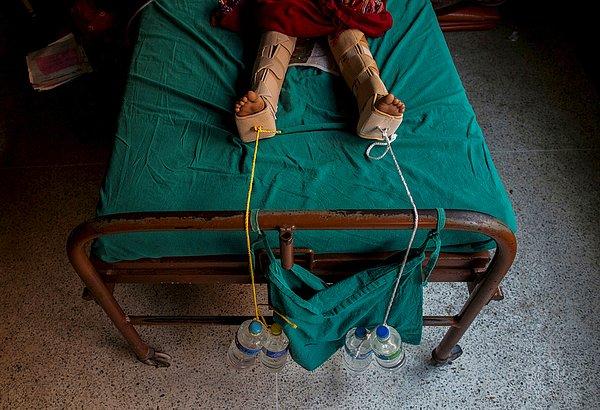 38. Depremde yaralanan bir kızın bacaklarına, su şişeleri ve halatlardan oluşturulmuş sistemle tedavi uygulanıyor. Katmandu Nepal. 29 Nisan 2015.