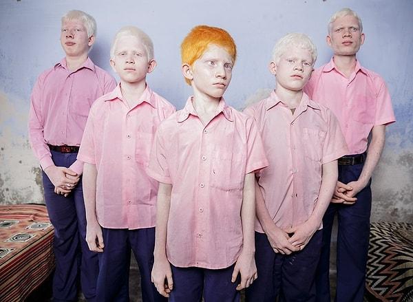 23. Görme engelli albino çocuklar.