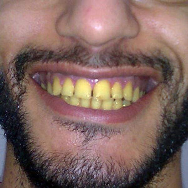 9. Eskiden altın diş bir ayrıcalıkmış, bugün bu geleneği sapsarı dişlerle yaşatmaya çalışmanın alemi yok ki?