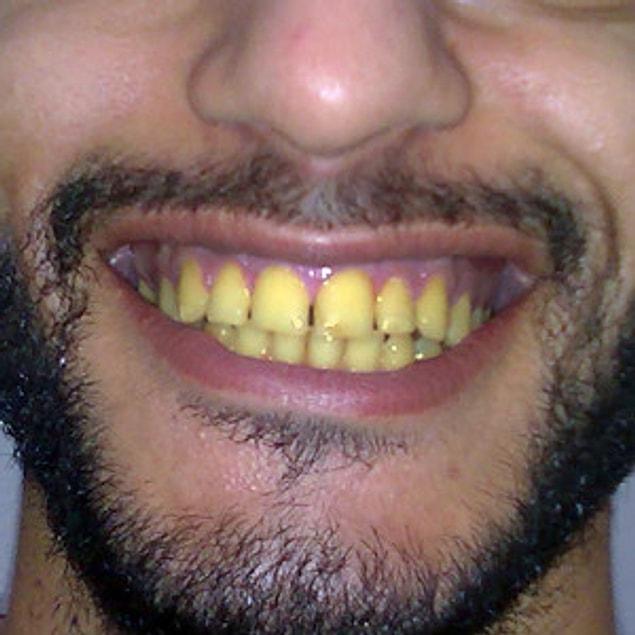 Eskiden altın diş bir ayrıcalıkmış, bugün bu geleneği sapsarı dişlerle yaşatmaya çalışmanın alemi yok ki?