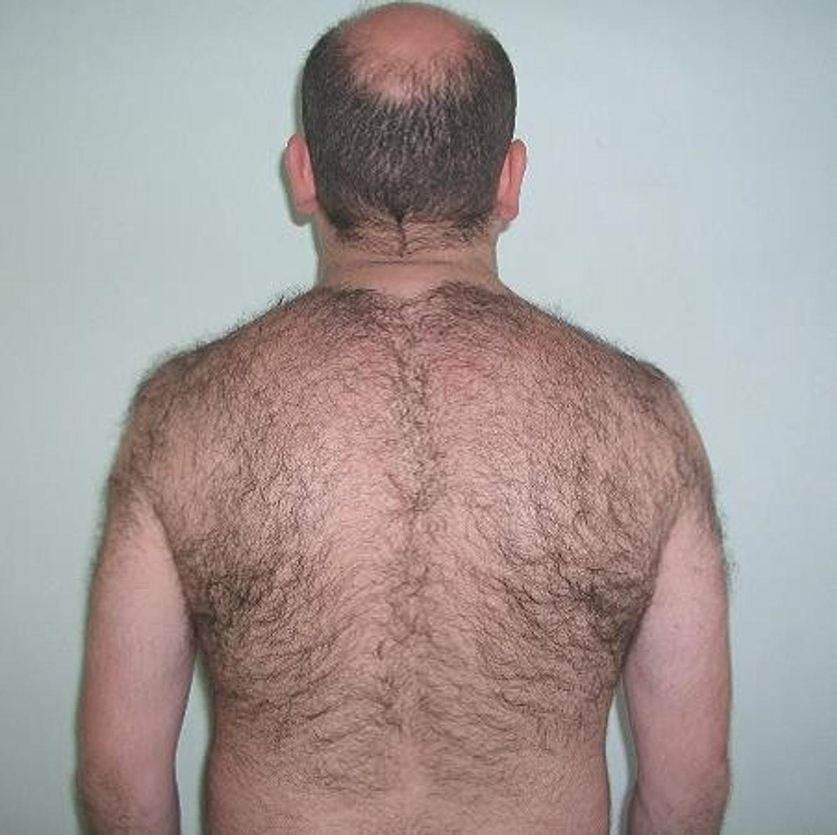 выпадение волос с груди мужчин фото 103
