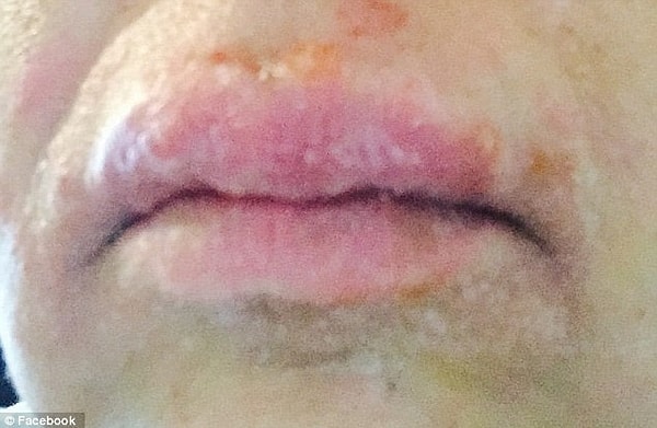 Мы, конечно, не можем утверждать, что бальзам вызывает аллергию у каждого, но прецеденты были.