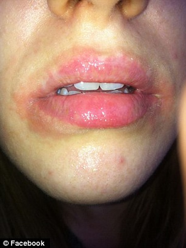 Раны не заживали неделями, и девушки решили подать в суд на эту марку.