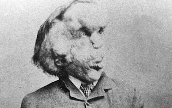 4. Джозеф Меррик