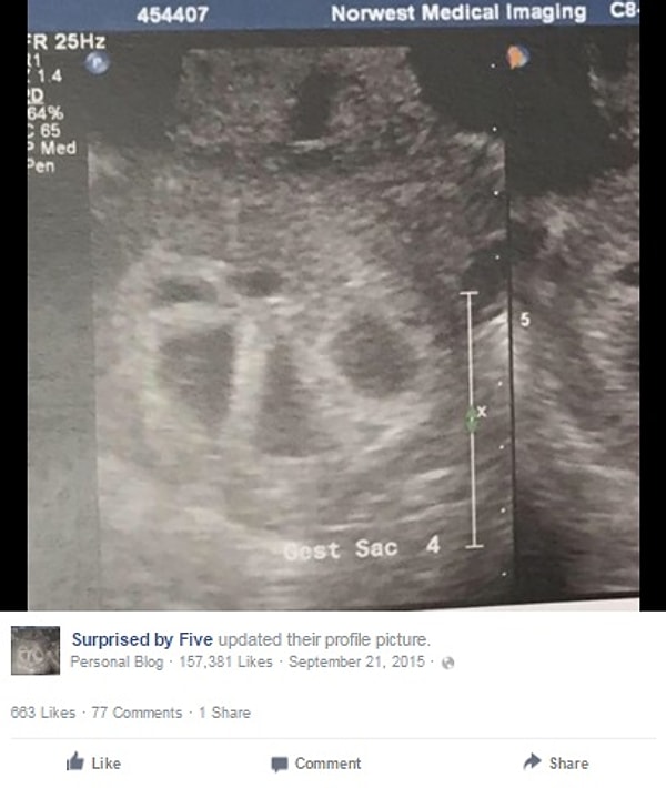 На ее первом УЗИ врач увидел несколько плодных яиц. А точнее, ПЯТЬ!