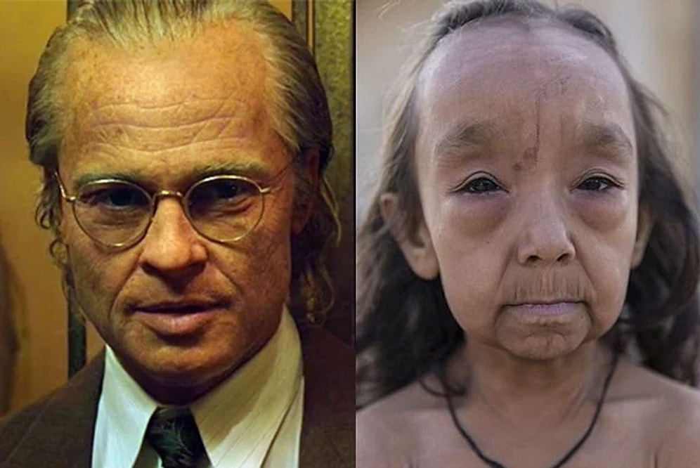 Дети с болезнью Бенжамина Баттона