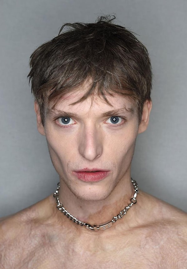 За 3 с лишним месяца большая часть поражений практически излечилась самостоятельно. Однако для восстановления оставшихся, парню пришлось перенести 10 операций!