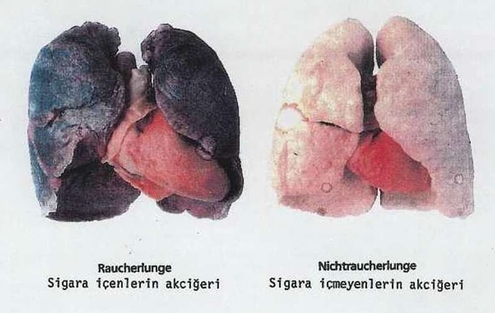 Kanser Hastalarının İlaç Parasına Sigara İçmeme Şartı Gelirken Aklımıza Takılan 13 Soru