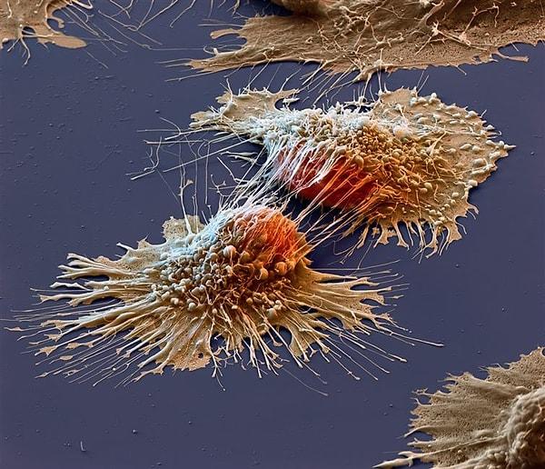 1. Bir kanser hücresinin elektron mikroskobu altındaki görüntüsü.