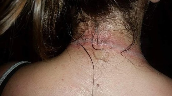 Мобильный телефон стал причиной сильного ожога у 13-летней девочки