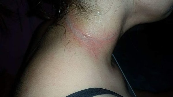 4. Габи сказала, что говорила по телефону, пока он стоял на зарядке. Внезапно телефон испустил электрический разряд, который прошел через ожерелье девушки и обжег ее шею.