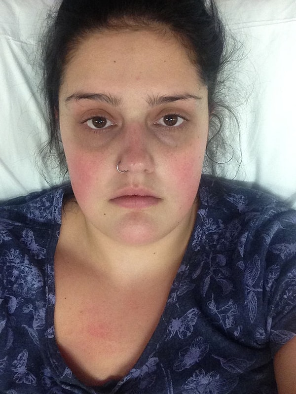 4. Пэнкхерст вытащила инфицированный тампон после того, как обнаружила кровянистые выделения и распухший живот. Через несколько часов она почувствовала слабость, ее речь стала невнятной и ее отправили в больницу.