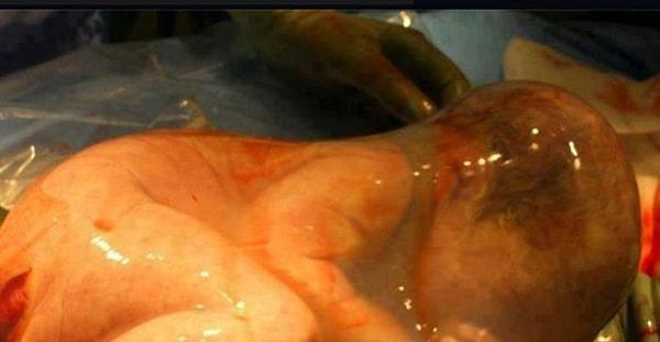 4. Üç ay erken doğan Silas bebek doğduktan sonra göbek kordonu plasentadan oksijen almaya devam etmiş.
