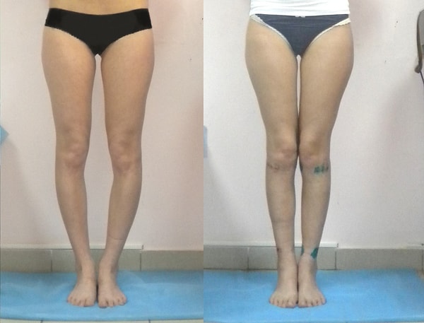 5. Коленки не сходятся