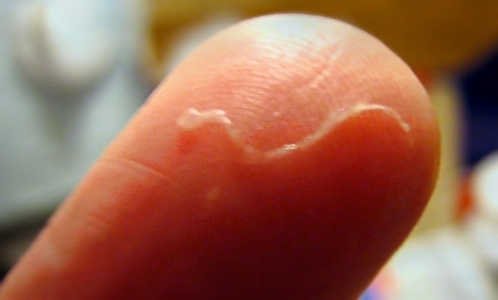 İnsan Gözüne Girebilen ve Orada Yaşayan 19 Cm Boyunda Bir Kurtçuk: Nematod