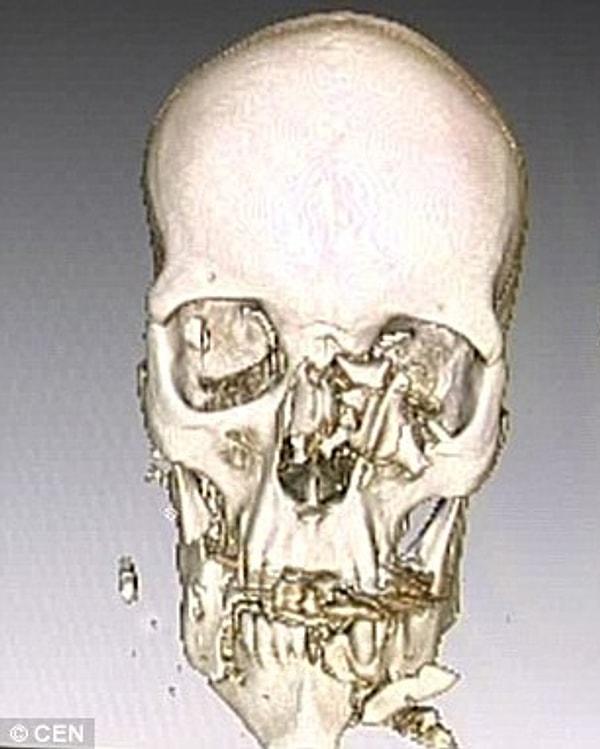 Saldırıdan tuz buz olmuş bir kafatası ve parçalanmış bir yüzle de olsa kurtulmayı başarmıştı.