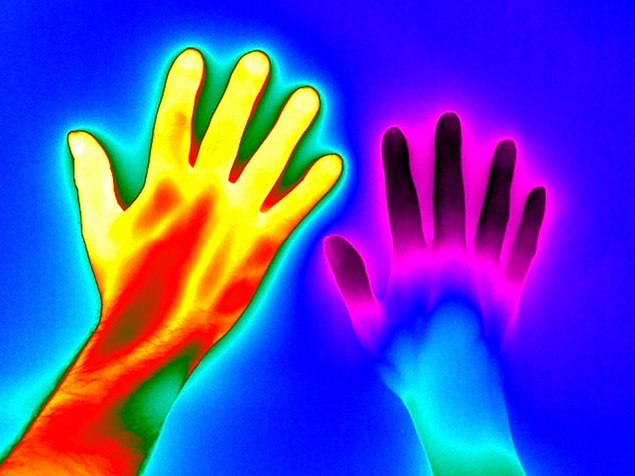 3. Raynaud Fenomeni