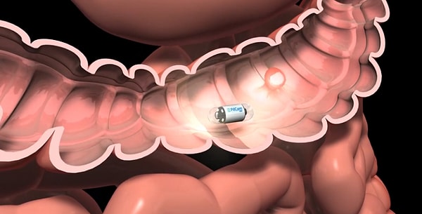 18. Вы можете проглотить маленькую камеру-капсулу вместо колоноскопии