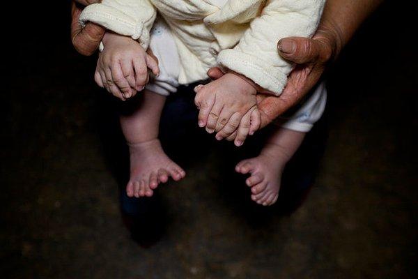 Hong Hong'un durumu bundan çok daha ciddi.    Ocak ayında Hunan bölgesinde dünyaya gelen bebeğin toplam 15 el ve 16 ayak parmağı var. Her elinde de ikişer avuç içi olduğu gibi baş barmakları yok.