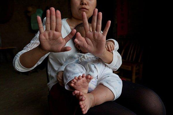 Hong Hong'un annesinde de poldaktilizm rahatsızlığı var. Onun da toplamda 12 el ve 12 ayak parmağı var.