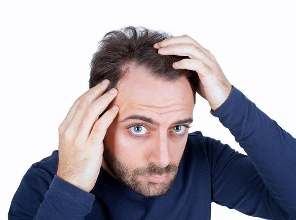 7. 30'lu yaşların ortalarına gelen erkeklerin %40'ı saçlarını fark edilebilir biçimde kaybetmektedir.