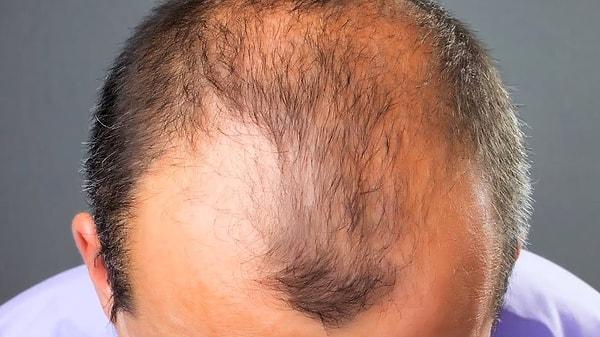 15. Erkek tipi saç dökülmesinin temel sebebi, saç köklerinde bulunan keratinosit hücrelerin testosteron hormonuna aşırı duyarlı olmasıdır.