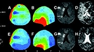 Beyni İncelenen Epilepsi Hastasından Beklenmedik Tepki: Tanrıyı Gördüm!