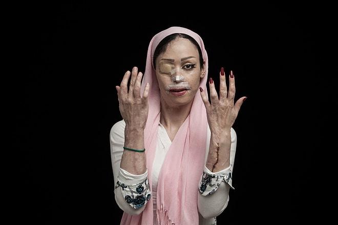 Asit Saldırısı Kurbanlarını Görüntüleyen İranlı Fotoğrafçıdan Yürek Parçalayan Kareler