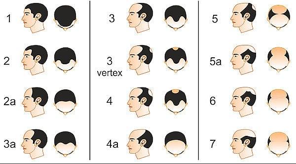 9. Saç dökülmesinin çeşitli süreçleri var.
