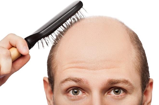 Kellik Çözümsüz Bir Sorun Değildir: 22 Maddeyle Saç Dökülmesini Durdurmanın Yolları