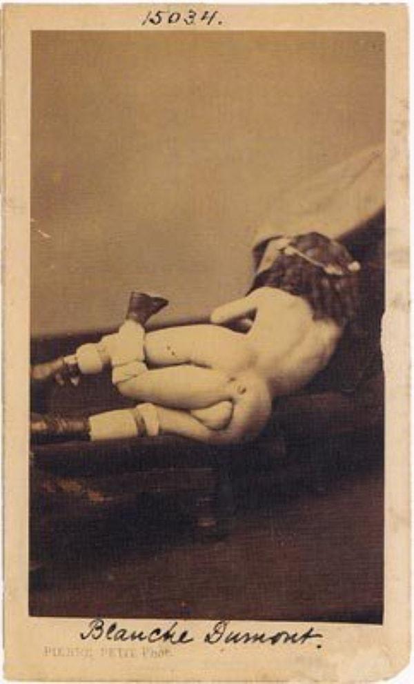 14. Müzede sergilenen fotoğraflardan birisi de Juan Baptista Dos Santos'a ait, 3 ayaklı ve 2 penisli olarak bilinen bir adama.