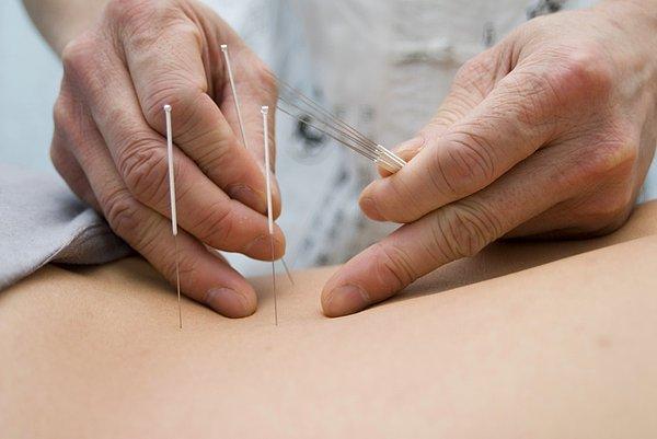 20. Oruçlu kimse akupunktur yaptırabilir mi?