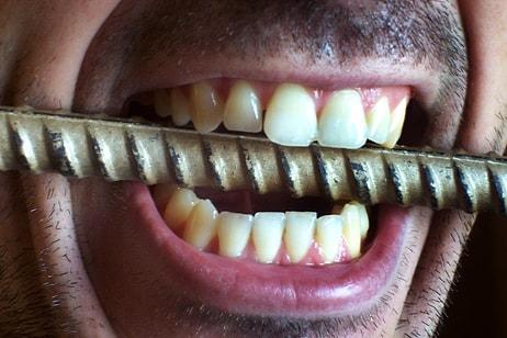 Farkında Olmadan Çenesini Sıkıp, Dişlerini Kıranların Muzdarip Olduğu Hastalık: Bruksizm
