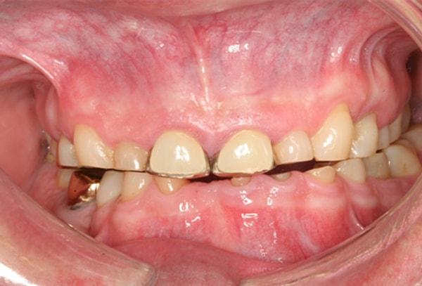 Tüm bunların ötesinde ise, bruksizm rahatsızlığı fazlasıyla ilerleyenlerin karşılaştığı bir diğer sorun ise, dişlerini kırmak.