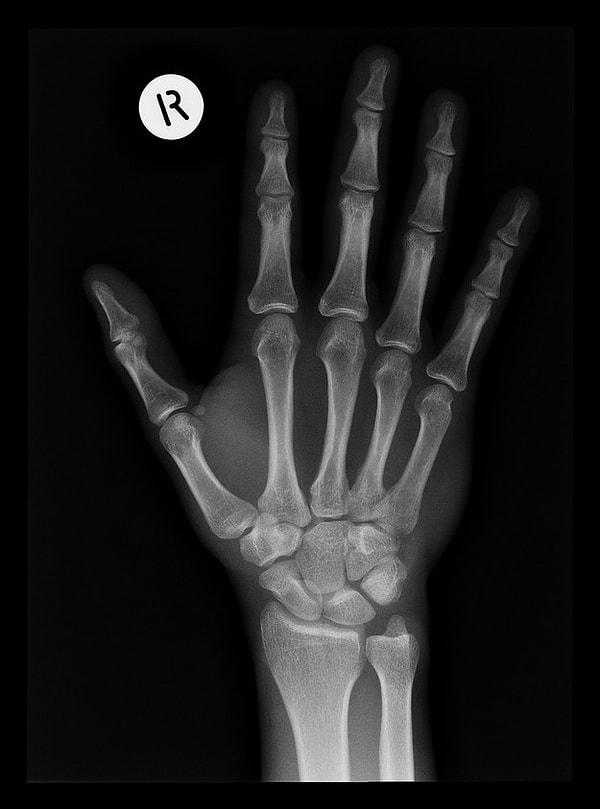 3. X-ray