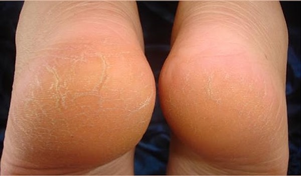 16. Перед сном нанеси большое количество увлажняющего крема на пяточки и надень носки. Делая это каждый день, тебе удастся добиться невероятной мягкости!