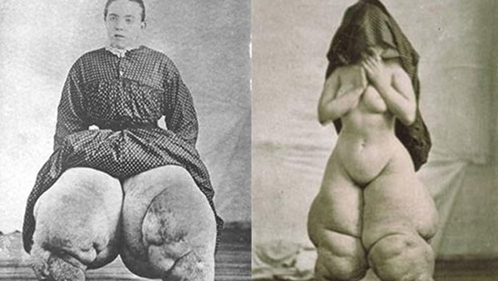 Что такое элефантиаз или слоновая болезнь