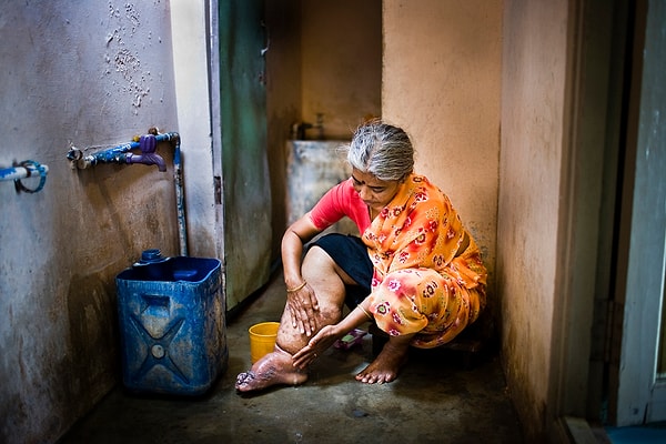 3. Одной из таких болезней, вызываемой паразитами, является слоновая болезнь.