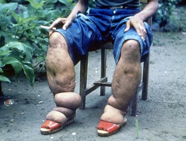 7. В последствии утолщения кожи очень напоминают кожу слона (отсюда и название болезни).